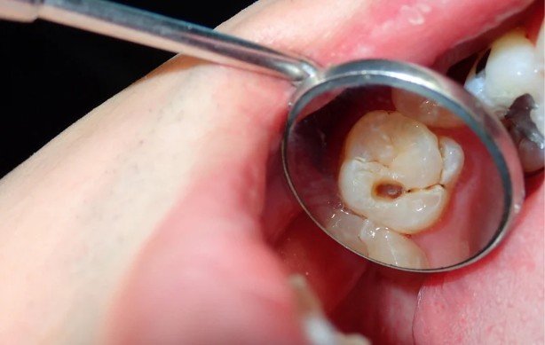 Unexplained Mouth Sores, White Patches, or Oral Lesions